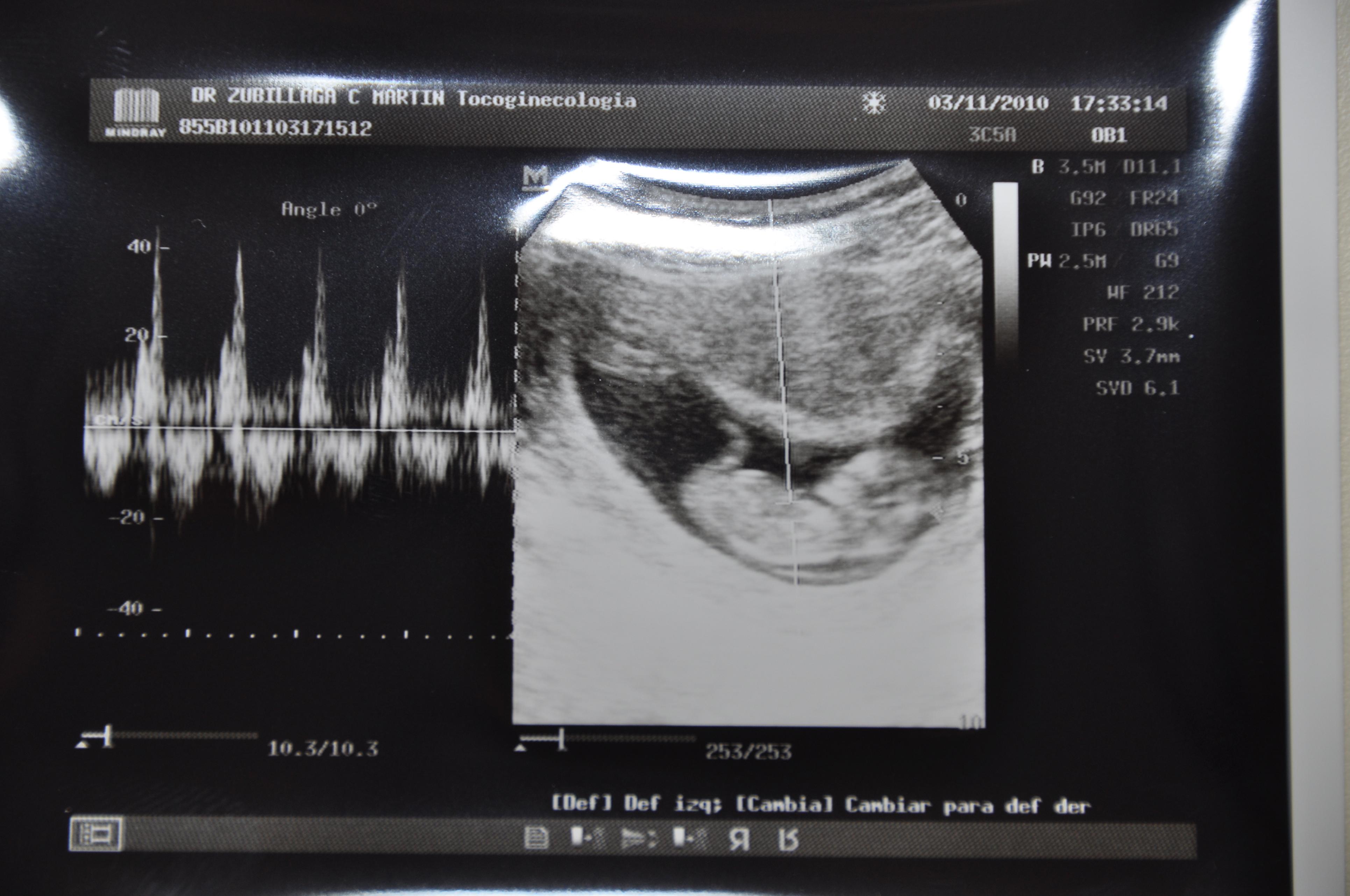 Ecografia 03-11-2010(1).jpg